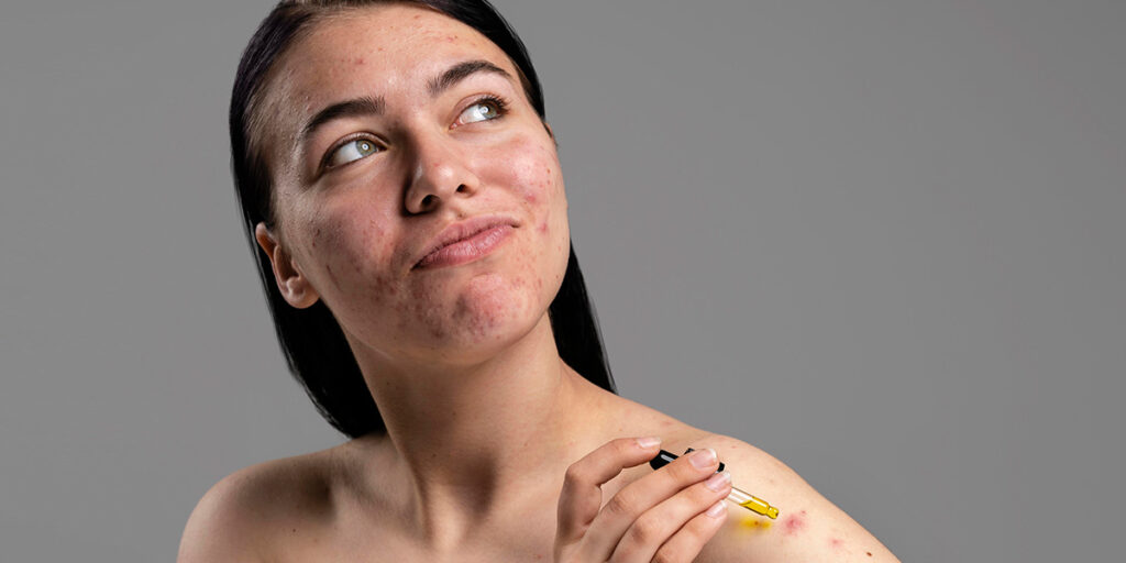 Mulher com cicatriz de acne colocando ácido na pele - Dra. Sarah Brasil dermatologista de Belém do Pará