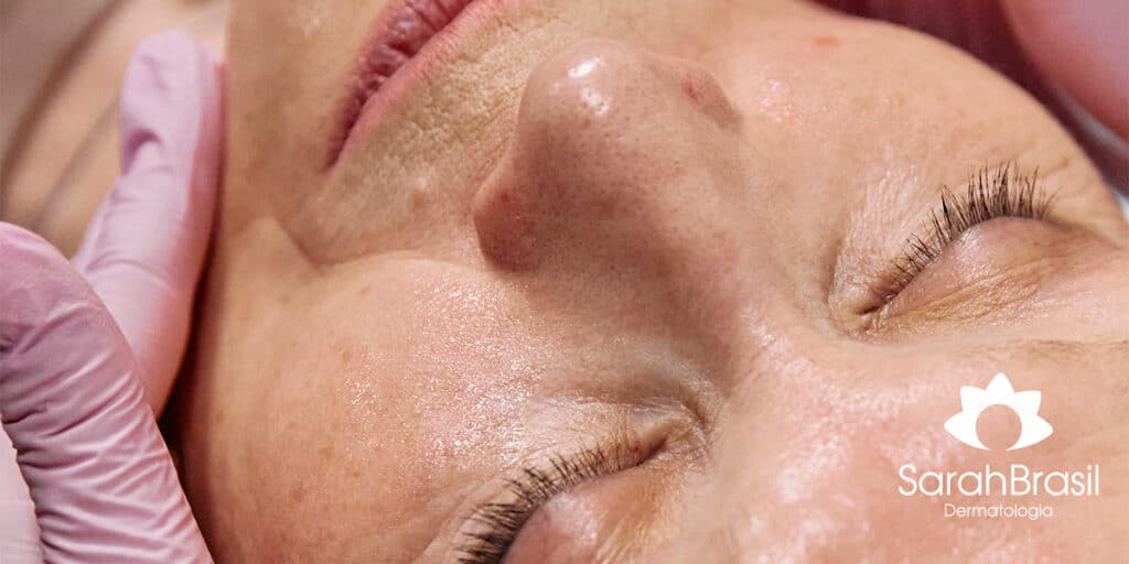Mulher fazendo tratamento estético facial contra rugas - Dra. Sarah Brasil dermatologista e esteticista de Belém - PA