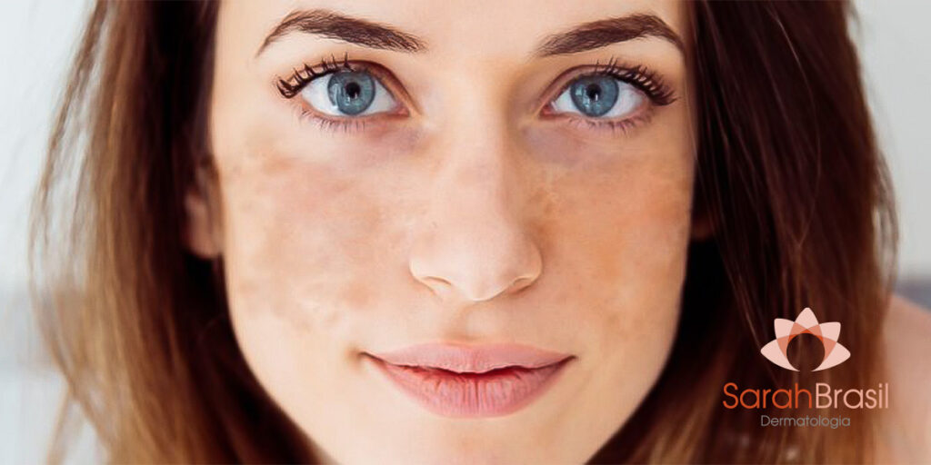 Mulher ruiva com manchas no rosto - Dra. Sarah Brasil dermatologista de Belém - PA