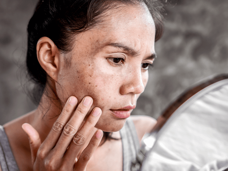 controlar-mancha-melasma-resistente